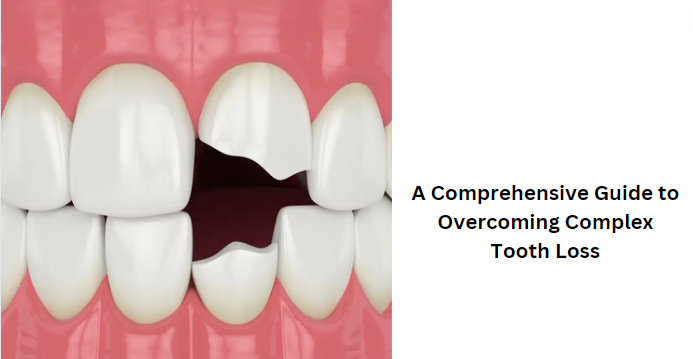 A Comprehensive Guide to Overcoming Complex Tooth Loss