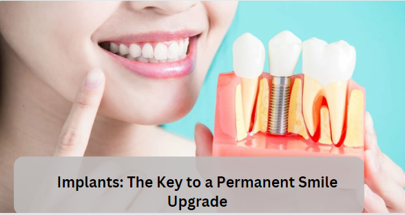 Implants: The Key to a Permanent Smile Upgrade